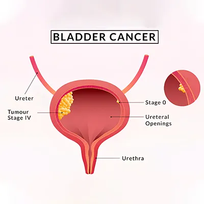 Bladder Cancer